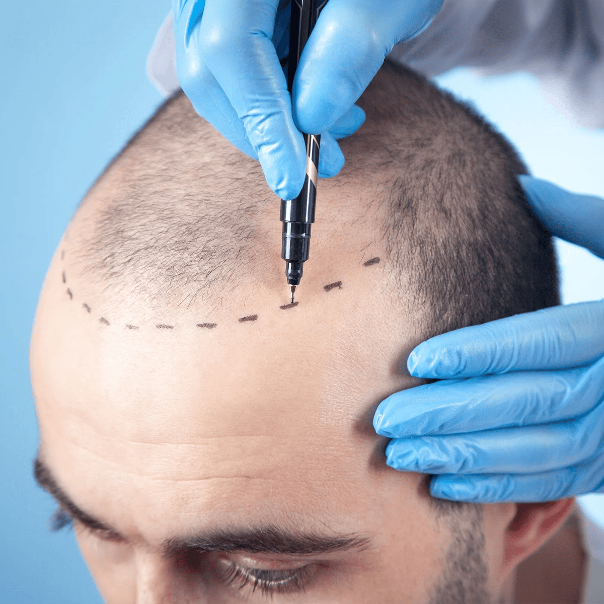 fue-teknik-img Fue teknik img