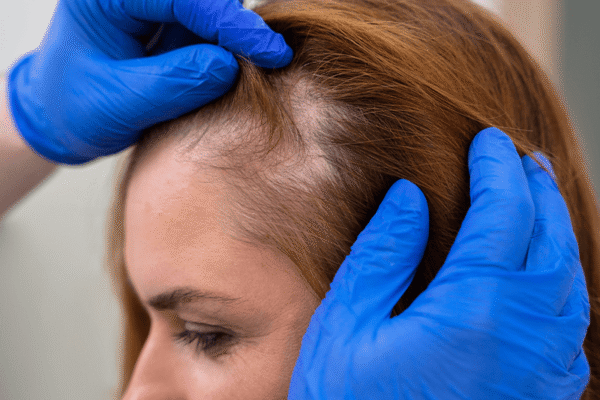 kadinlar-icin-sac-ekimi-img1