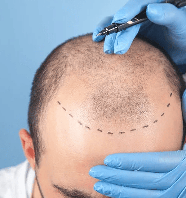 Sac ekimi agrilimi img 600x640