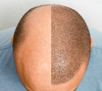 Sac ekimi sonrasi img 360x320