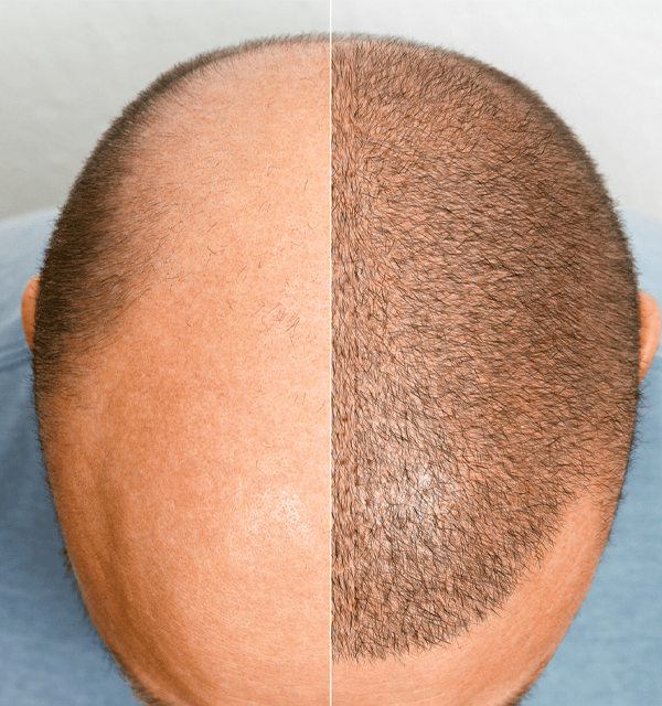 Sac ekimi sonrasi img 600x640