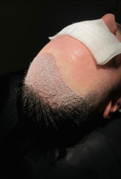 tirassiz-sac-ekimi-img1